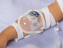 750LFP I.V. House UltraDome on toddler's elbow