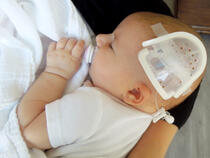 750LFP I.V. House UltraDome on infant's scalp